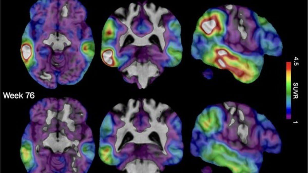 Blood test for Alzheimer's offered to NHS patients - it can predict disease decades before symptoms hit